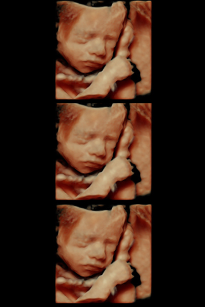 ecografia 5d para bebes en madrid